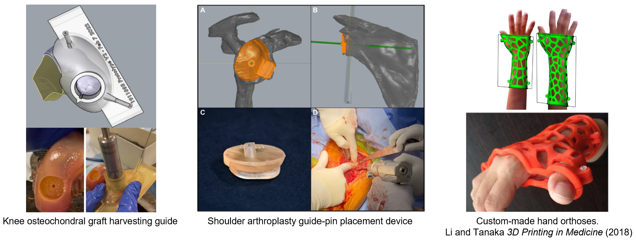 Personalized Surgical Instrumentation; Orthotics with Arial