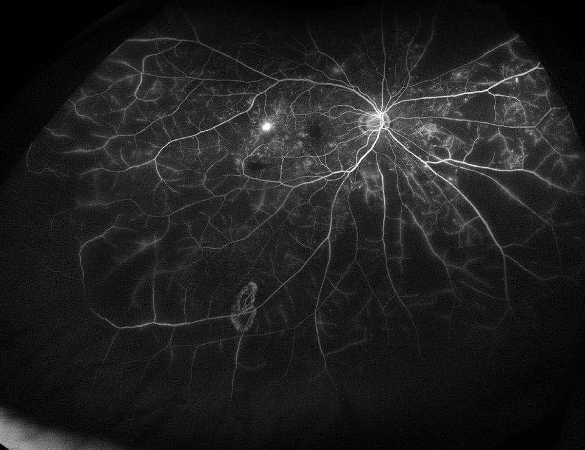 Diabetic Retinopathy New Image Resized