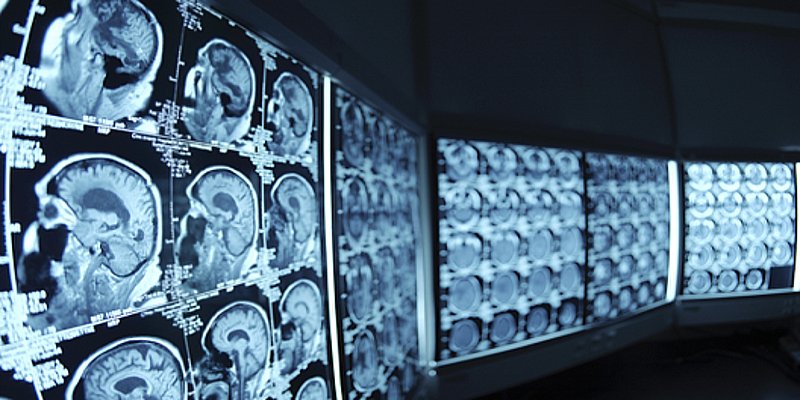 Monitors displaying radiologic imaging of brain scans