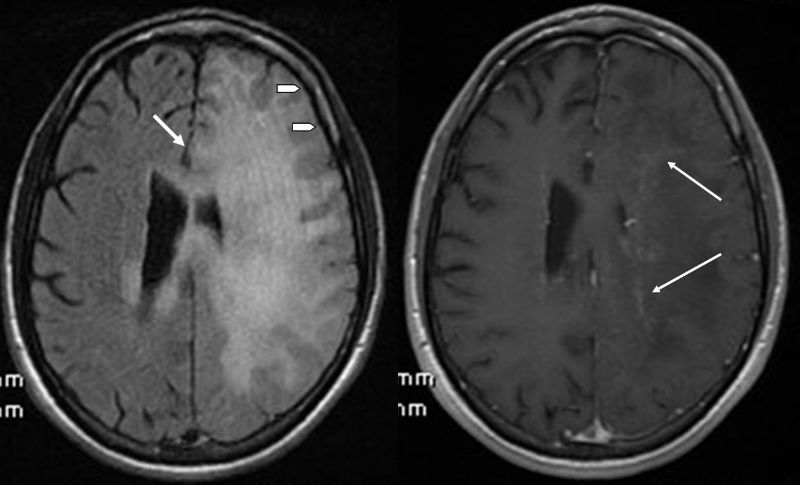 PML-IRIS survivor brain