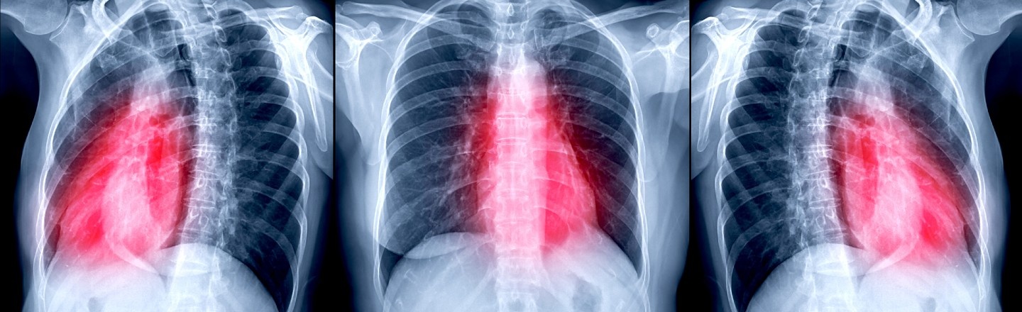 Three radiologic images of a human chest