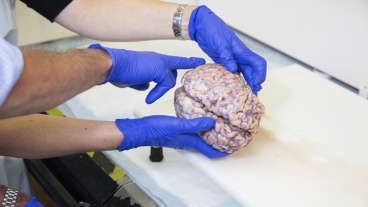 Genes Found Related to the Reduction of Proteins That Contribute to Alzheimer’s Onset