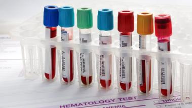 A row of blood samples with brightly colored lids sit upright in a container.