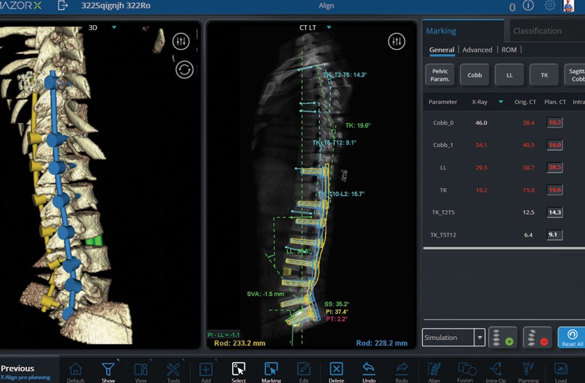 New Robotic Technology Enhances Spine Surgery
